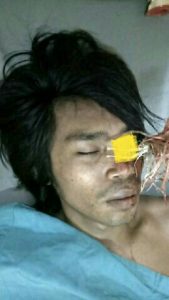 Tragedi Penganiayaan di UHO , Anak Panah Bersarang Di Mata Juru Parkir