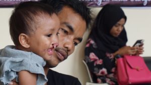 Senyum Bersama Polri, Polda Sultra Targetkan Rekor Muri Operasi Bibir Sumbing