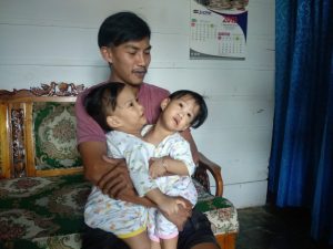 Nasib Batita Kembar Siam di Kendari, Keluarga Tak Sanggupi Biaya Operasi Milyaran Rupiah